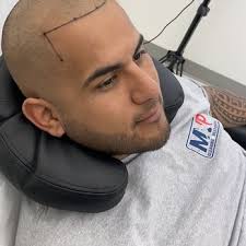 EVOLUTION 360° SCALP MICROPIGMENTATION