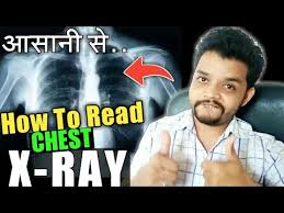 How To Read Chest X Ray In Hindi Gyanear Youtube