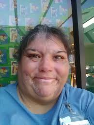 Here's an update to my post the other day of my post surgery arterial line  hematoma! We found out today I've got a superficial venous thrombosis in  the basilic vein branch by