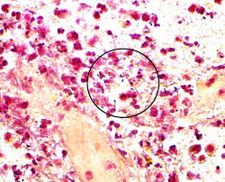 Listeria monocytogenes gram stain west nile encephalitis creutzfeldt jakob disease haemophilus influenzae type b oral polio vaccine. Cureus Multiple Listeria Abscesses In An Immunocompetent Patient