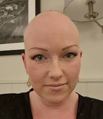 Hi! I'm new to this group. I recently joined because I am starting a  support group for AlopeciaUK in Canterbury and need your help x
