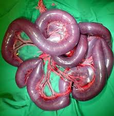 Image result for Volvulus