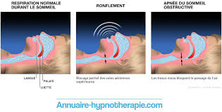 Et si c'était les signes d'une apnée du sommeil avancée ? Apnee Du Sommeil L Hypnose Fonctionne Annuaire Hypnotherapie
