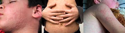 Image result for measles