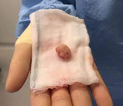 Tumours (also called growths) can be cancerous or. Cat With Two Brain Tumours On Road To Recovery Vet Times