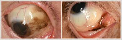 Image result for melanosis sclera