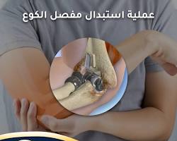 صورة مفصل الكوع