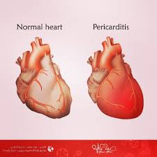 التهاب الغشاء التاموري Pericarditis Normal Heart Clinic Cardio