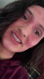 For those who wanted a transition without makeup❤️ I wasn’t able to open my  mouth so this was my awkward smile 😂#eczema #withdrawals #fyp