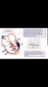 Image result for Q Wave