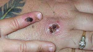 The time from exposure to onset of symptoms is around 10 days. Monkeypox Two Cases Identified In North Wales Bbc News
