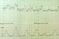 Contractions : comment savoir si c est le moment de se rendre la