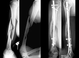 Humerus Fractures Op Dr Taner Bekmezci