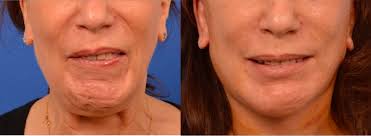 Bells palsy tips and takeaways on what do know and do (and don't do) when you're diagnosed by bell's palsy survivor, holley grainger. Mukanya Herot Sebelah Coretan Wanita Ini Tentang Bell S Palsy Sentuh Perasaan Netizen Nona