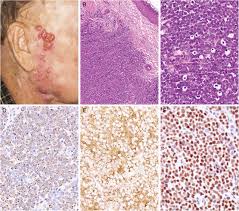 Merkel cell carcinoma treatment options include surgery, radiation therapy, and chemotherapy. Molecular Characteristics And Potential Therapeutic Targets In Merkel Cell Carcinoma Journal Of Clinical Pathology
