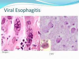 Symptoms include pain or a burning sensation behind or below the sternum, the flat bone that runs. Http Www Bph Moph Go Th Wp Content Uploads 2019 03 12bp Pdf