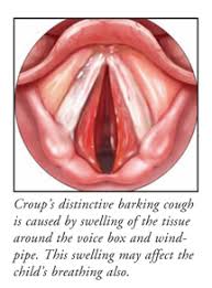 Image result for Croup