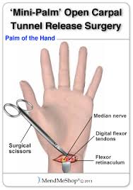 Wrist Surgery And Post Operative Rehabilitation Carpal Tunnel Carpal Tunnel Syndrome Carpal Tunnel Surgery