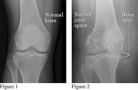 Image result for Knee XRay