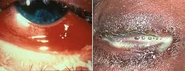Image result for gonorrhea symptoms