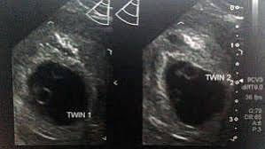 On my ultrasound at 6 weeks 5 days the heartbeats were completely opposite of eachother. Twin Ultrasound At 6 Weeks Detection Risk About Twins