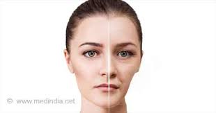 Parry-Romberg Syndrome