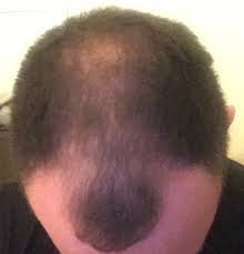 The old skin is shed. Minoxidil Dermaroller So Far So Good 5 Weeks Pictures Hairlosstalk Forums