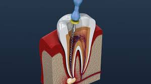 Building the foundation for the crown is another possible step that may hurt. How Long Does A Root Canal Take In 2020 Smile Angels Of Beverly Hills