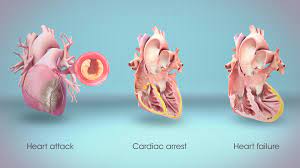 Heart failure, we must know about cardiac arrest first. Heart Attack Cardiac Arrest And Heart Failure They Are All Different