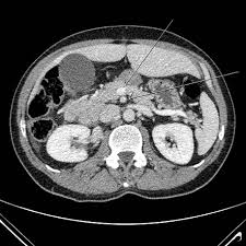 Image result for Intestinal Malrotation