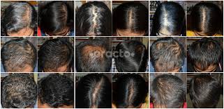 Homeopathic prescriptions for balding show a decent long haul reaction in hair diminishing. Dr Snigdhodip Saha Homoeopath Book Appointment Online View Fees Feedbacks Practo