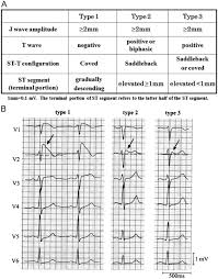 They will not enter paradise and will not even smell its fragrance, although its fragrance the meaning of their heads looking like humps of camels is that they arrange it so that it seems big and raised by either using a turban, a wrap or something similar. Ecg Interpretation In Brugada Syndrome Sciencedirect