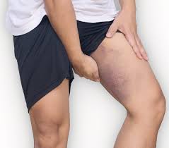 Kopf des musculus quadriceps femoris (vierköpfiger oberschenkelmuskel) und streckt das kniegelenk. Adduktorenschmerzen Und Zerrungen Oberschenkel Selbst Behandeln Liebscher Bracht