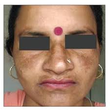Melasma (Chloasma): Pathogenesis and Treatment