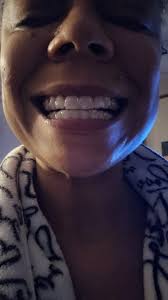 Do others have button spots