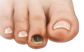 Your black toenail treatment does, of course, depend on the reason for the problem. Black Toenail Causes Treatment And Prevention
