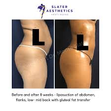 At mia aesthetics we provide the highest quality plastic surgery, all at affordable prices. 1 Brazilian Butt Lift Results By Dr Monte Slater 2 Locations In Ga