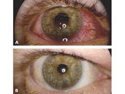 A Powerful Option For The Treatment Of Bacterial Conjunctivitis Ophthalmologyweb Com