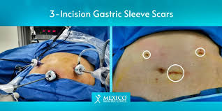 Alexander makes only small incisions through which the surgery is performed with the aid of a special device called a laparoscope. Gastric Sleeve Scars Guide To Reduce Scarring Quickly