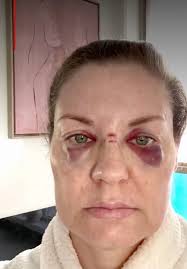 Mujer acusa a Axl Rose de dejarla ensangrentada tras lanzarle su micrófono  en la cara en un concierto de Guns N Roses y él responde — Rock&Pop