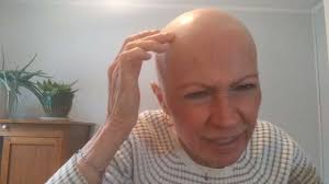 Anniversary GLAM & Lace Wig INSTALL (hair loss/alopecia)