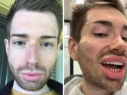 Un joven se gasta 70.000 euros en cirugías para convertirse en un 'Ken  Humano'