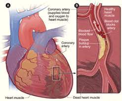 Disorders Of Circulatory System Angina Heart Attack Hypertension Etc