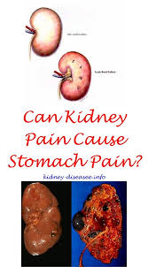 Pin On Kidney Infection Severe