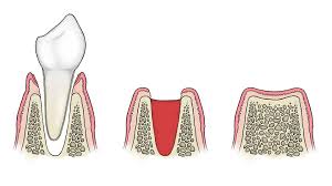 Lying flat may prolong bleeding. How Long Does It Take The Hole To Close After Tooth Extraction