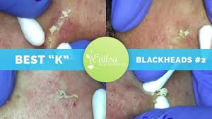 I saw that people were tagging their friends or commenting about how amazing it was, the dermatologist. K S Best Blackhead Extraction Compilation Part 2 Youtube