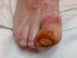 Image result for diabetic toes