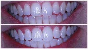 This includes tea, coffee, red wine, cola, etc. Teeth Whitening In Charleston Wv Simpson Dental