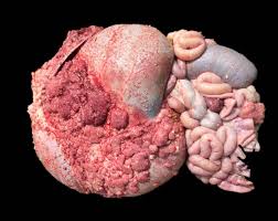 If you have been diagnosed with adenocarcinoma cancer, you have a cancer that developed in one of the glands that lines the inside of your organs. Conference 06 2020 Case 04 20200930