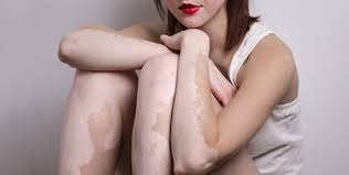 A person has a few vitiligo spots in a single area. Vitiligo Rhazes Global